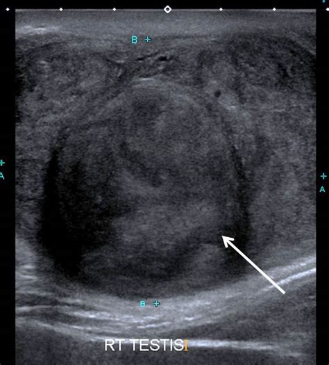 Testicular Cancer Embryonal Cell Carcinoma Radiology Cases