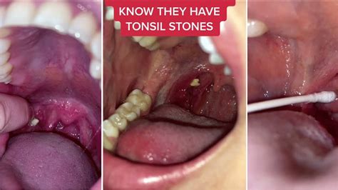 Tonsil Stones Removal Compilation 2021 Youtube