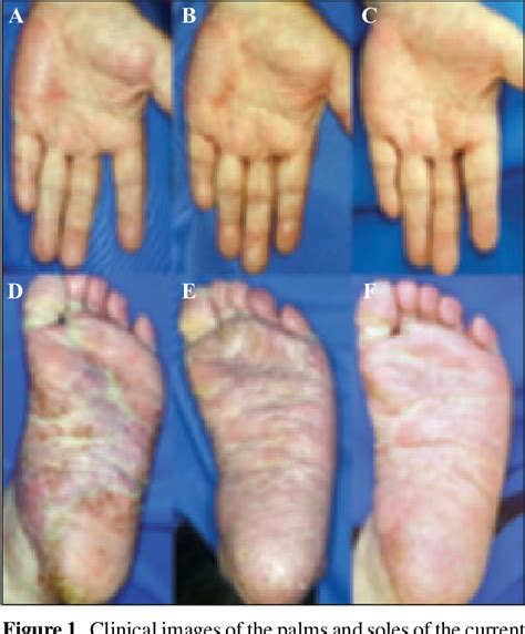 Figure 1 From Successful Treatment Of Palmoplantar Pustular Psoriasis
