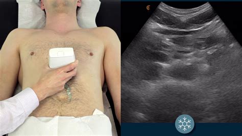 How To Scan The Abdominal Aorta To Assess For A Potential Aaa Youtube