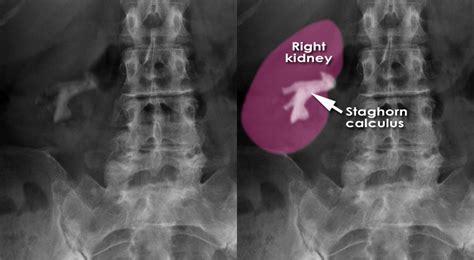 Abdominal X Ray Abnormal Calcification Renal Calcification