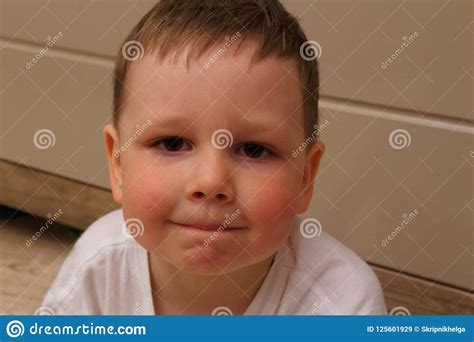 Portrait Of A Child A Boy With Red Cheeks From The Temperature From