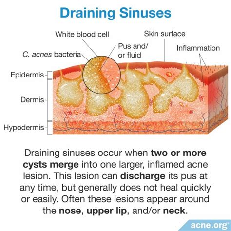 What Is A Draining Sinus