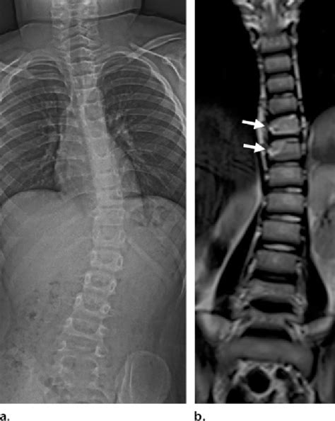 Figure 7 From Scoliosis Imaging What Radiologists Should Know 1