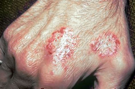 Eczema Numular Causas Sintomas E Tratamento • Mdsaúde