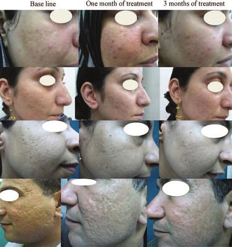 Representative Photographs Of Patients With Post Acne Scars In Response