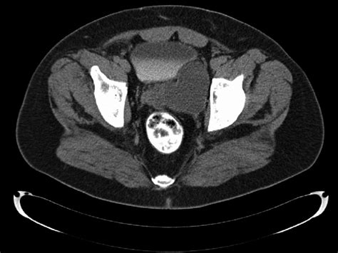 Preoperative Ct Scan Of Pelvis Showing The Left Seminal Vesicle Cyst