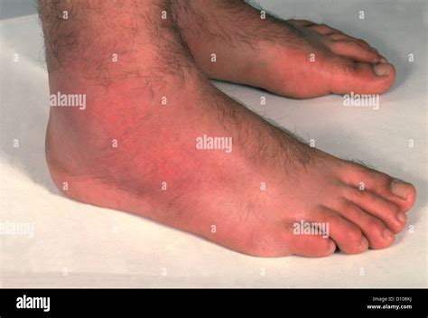 Cellulitis Hi Res Stock Photography And Images Alamy