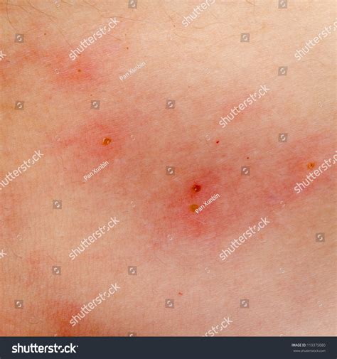 Ill Allergic Rash Dermatitis Eczema Skin Of Patient Stock Photo
