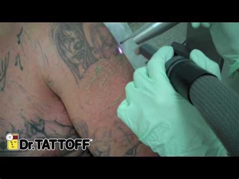 Find 1 listings related to free gang tattoo removal clinic in north dallas on yp.com. Laser Tattoo Removal - Removal of Tattoo of Clown Faces on ...