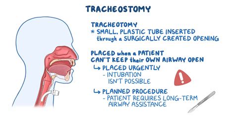 Tracheostomy Osmosis Video Library