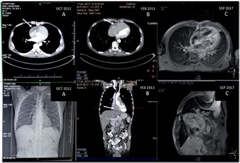 A Thoracic Ct Scan Showing Cardiac Tumor Spreading Into The Right