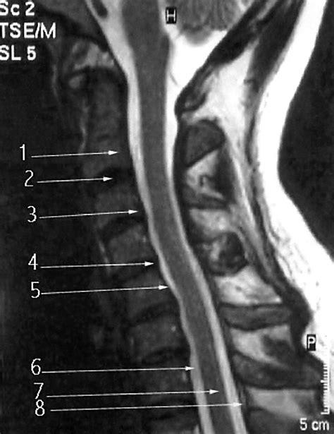 Surgical Disorders Of The Cervical Spine Presentation And Management