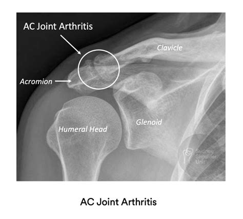 Severe Acromioclavicular Joint Osteoarthritis