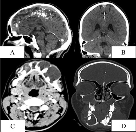 A B Plain Computed Tomography Brain Images Showing Calcification Of