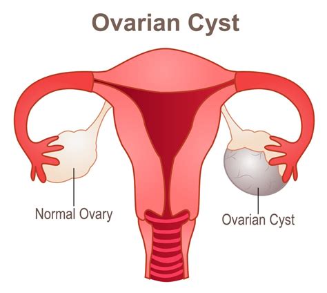 Ovarian Cystectomy Remove That Troublesome Cyst Sitaram Bhartia Blog