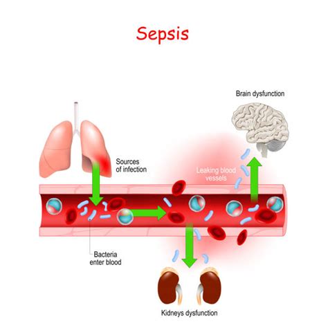 Sepsis Stock Photos Pictures And Royalty Free Images Istock