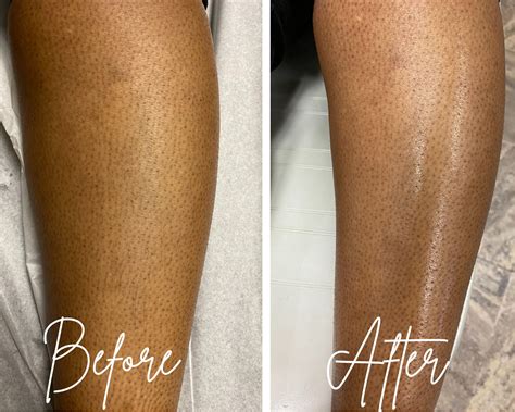 Before And After Of A Leg Wax Performed By Supervised Student Laurel