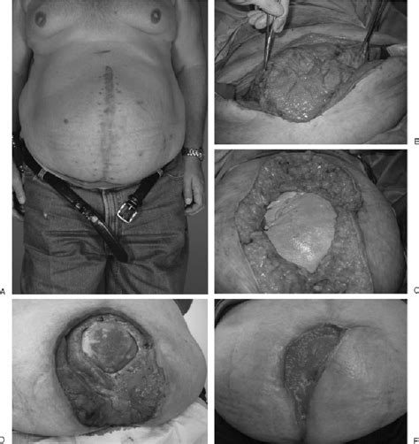 A A 50 Year Old Man With A History Of Recurrent Ventral Hernia
