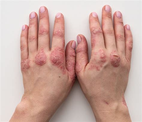 Psoriasis Triggers And Treatments Durban Skin Doctor