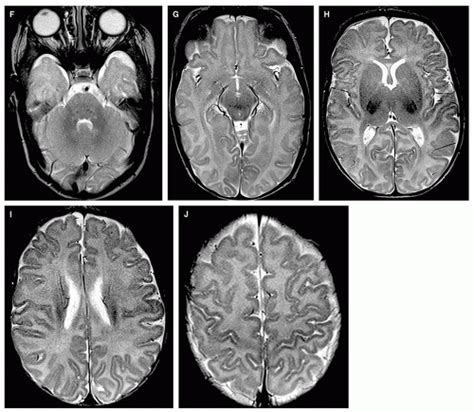 Normal Development Of The Fetal Neonatal And Infant Brain Skull And