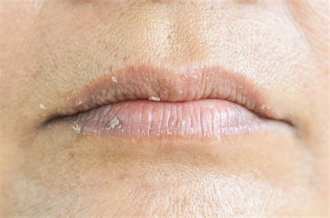 Hives On Lips Home Treatment Axis Medical