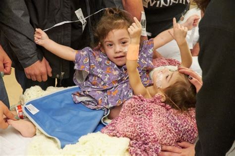 Conjoined Twins Successfully Separated At Packard Childrens Hospital