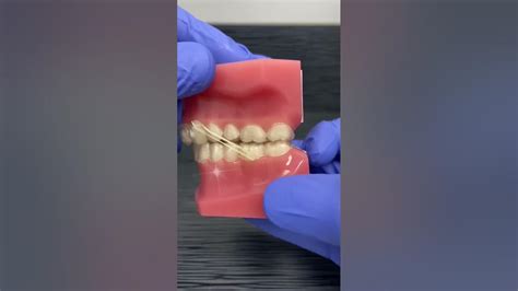 Invisalign Overbite And Rubber Bands Youtube