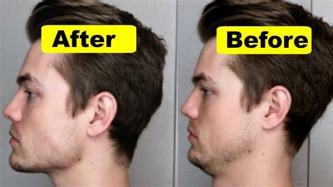 How To Get A Strong Chin And Jawline Lose Double Chin Youtube