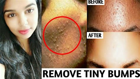 How To Get Rid Of Tiny Bumps On Forehead Or Face Natural Home Remedy Milia Home Remedy Youtube