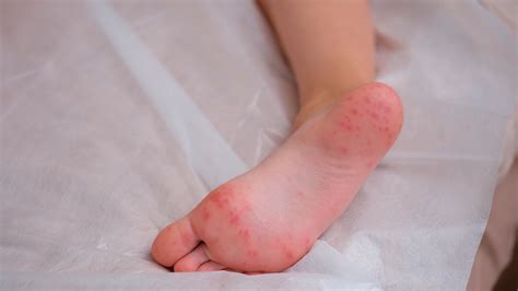 Dyshidrotic Eczema Feet