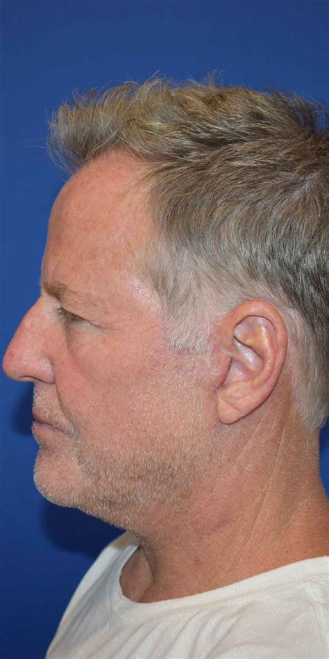 Neck Lift Case 2793 Facial Plastic Surgery Of Austin