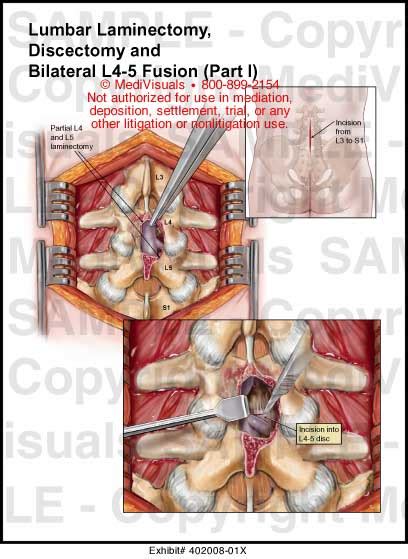 Lumbar Laminectomy Discectomy And Bilateral L4 5 Fusion Part I