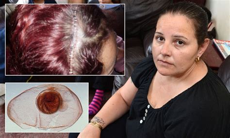 Mother Of Four Has Emergency Surgery After Her Brain Becomes Riddled With Tapeworm Larvae