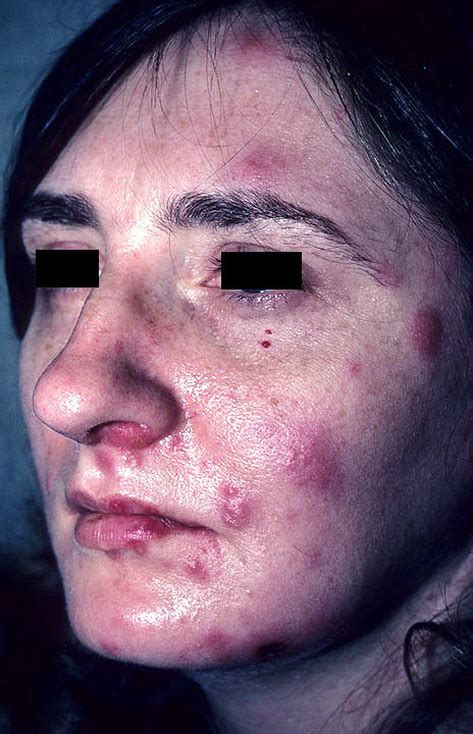A skin rash is a common symptom of hiv infections. Shingles on Face Pictures - 35 Photos & Images / illnessee.com