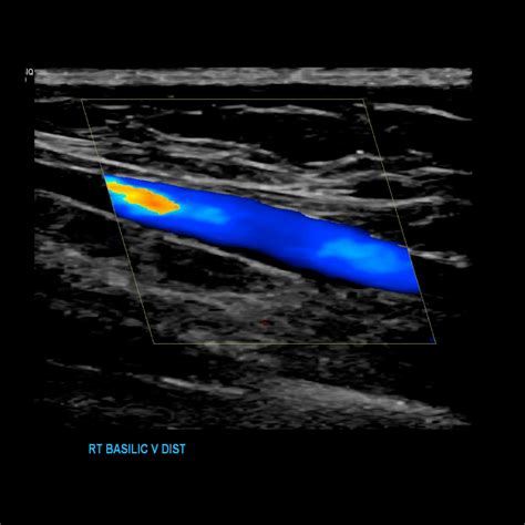 Upper Extremity Arterial Ultrasound