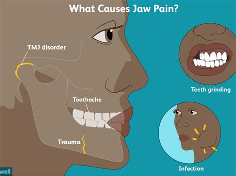 How To Relieve Sore Jaw - Birthrepresentative14