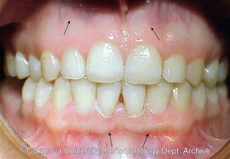 85 Atlas Of Periodontal Diseases Pocket Dentistry