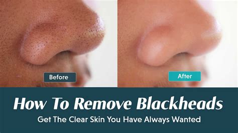 Best Ways To Remove Blackheads From Nose Easily Youtube