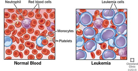 Leukemia Symptoms Signs Causes Types Treatment