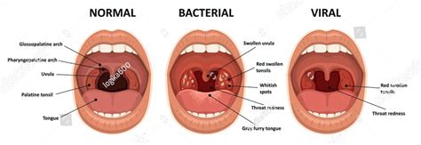 Tonsils Causes Symptoms And Treatment