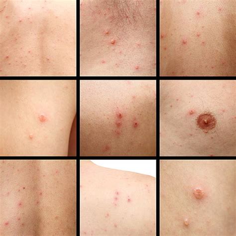 Chickenpox Adult Stock Photos Pictures And Royalty Free Images Istock