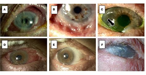 Ocular Mucous Membrane Pemphigoid Ommp Clinical Spectrum And Download Scientific Diagram