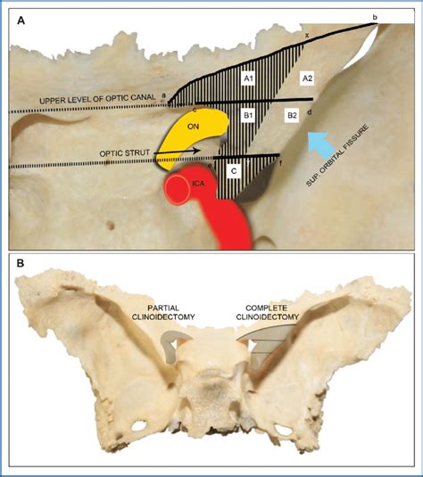 A Morphometric Subdivision Of The Anterior Clinoid Process Acp Based