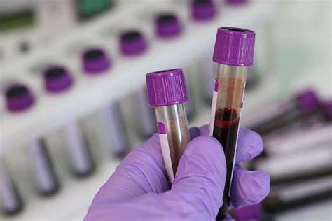 Bowel Cancer Blood Test Developed In Wales Could Save Thousands Of Lives