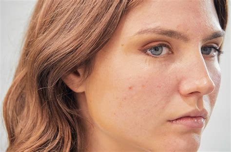 Uneven And Blotchy Skin Causes And Treatments The Bar