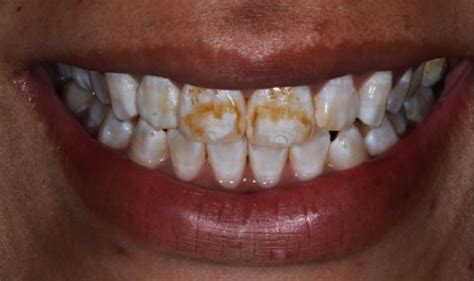 His Bonding Is The Wrong Color And Is Falling Off Cosmetic Dentistry Blog