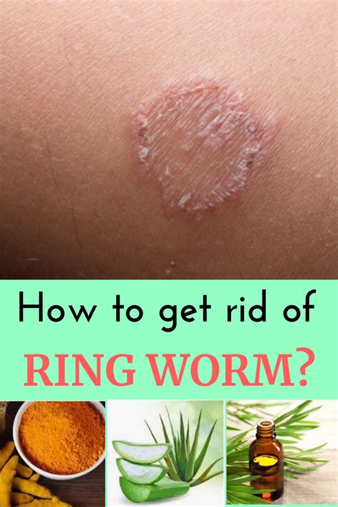 Super Effective Home Remedies To Get Rid Of Ring Worm Ringworm Skin