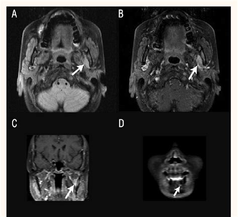 Axial T1 Weighted Magnetic Resonance Imaging Of A 56 Year Old Female