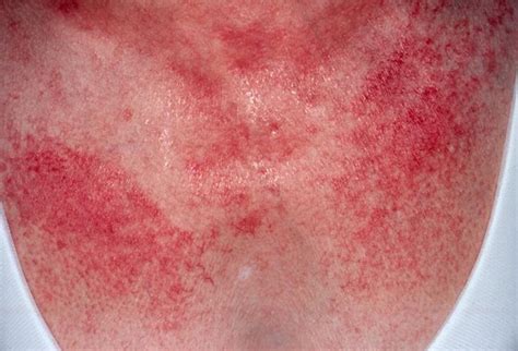 Cutaneous Manifestations Of Systemic Lupus Erythematosus Party